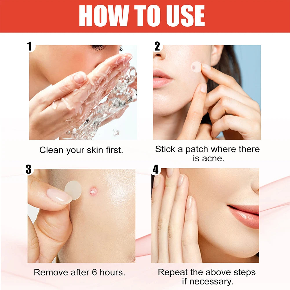 144pcs Hydrocolloid Acne Pimple Patches – 2 Sizes, Invisible Spot Stickers for Face Skin Care | Men & Women