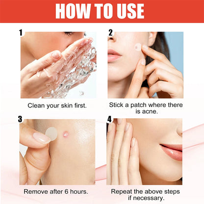 144pcs Hydrocolloid Acne Pimple Patches – 2 Sizes, Invisible Spot Stickers for Face Skin Care | Men & Women